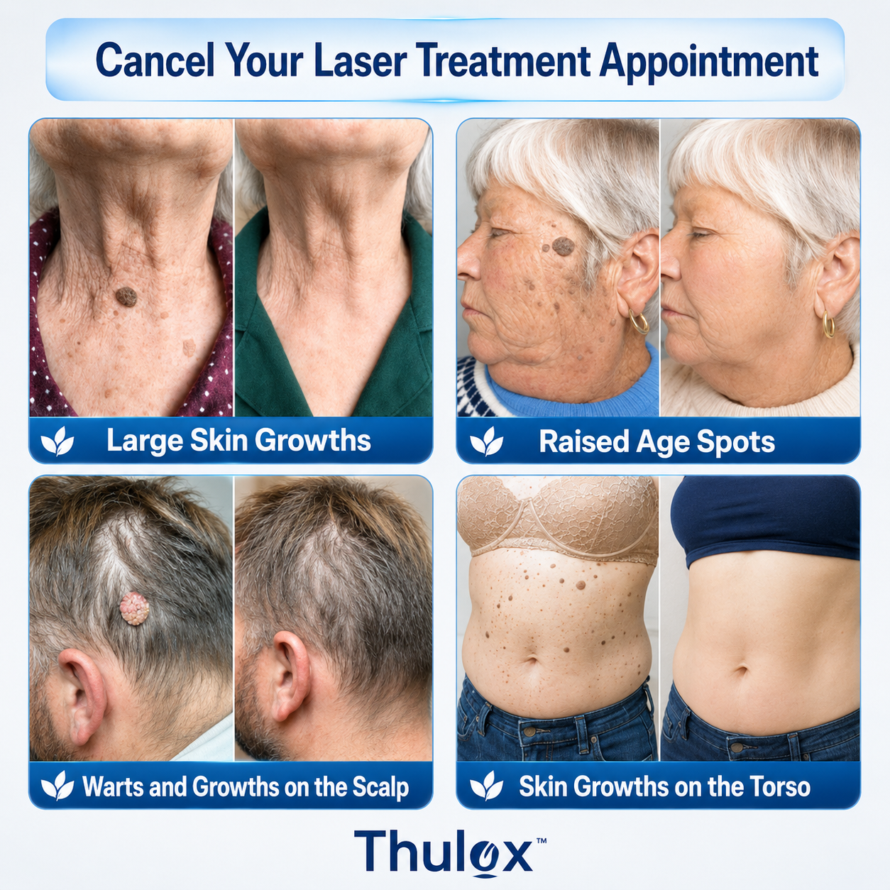𝐎𝐟𝐟𝐢𝐜𝐢𝐚𝐥 𝐒𝐭𝐨𝐫𝐞 𝐁𝐫𝐚𝐧𝐝 | Tlulox®  👩‍⚕️ 𝐓𝐥𝐮𝐥𝐨𝐱® 7-Day Skin Tag & Dark Spot Remover (Pain-free roll-on applicator · No scars · Gentle skin care solution) 🌱