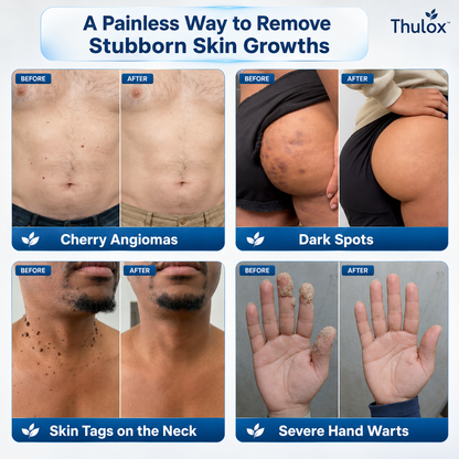 𝐎𝐟𝐟𝐢𝐜𝐢𝐚𝐥 𝐒𝐭𝐨𝐫𝐞 𝐁𝐫𝐚𝐧𝐝 | Tlulox®  👩‍⚕️ 𝐓𝐥𝐮𝐥𝐨𝐱® 7-Day Skin Tag & Dark Spot Remover (Pain-free roll-on applicator · No scars · Gentle skin care solution) 🌱