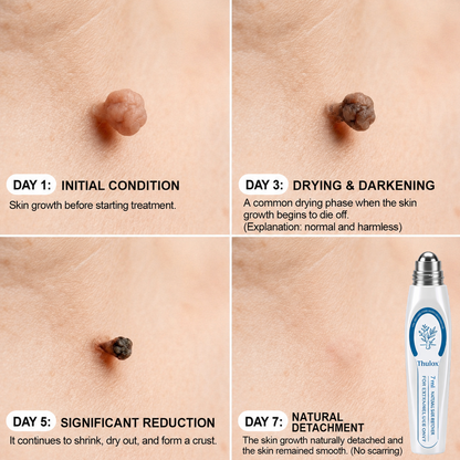 𝐎𝐟𝐟𝐢𝐜𝐢𝐚𝐥 𝐒𝐭𝐨𝐫𝐞 𝐁𝐫𝐚𝐧𝐝 | Tlulox®  👩‍⚕️ 𝐓𝐥𝐮𝐥𝐨𝐱® 7-Day Skin Tag & Dark Spot Remover (Pain-free roll-on applicator · No scars · Gentle skin care solution) 🌱