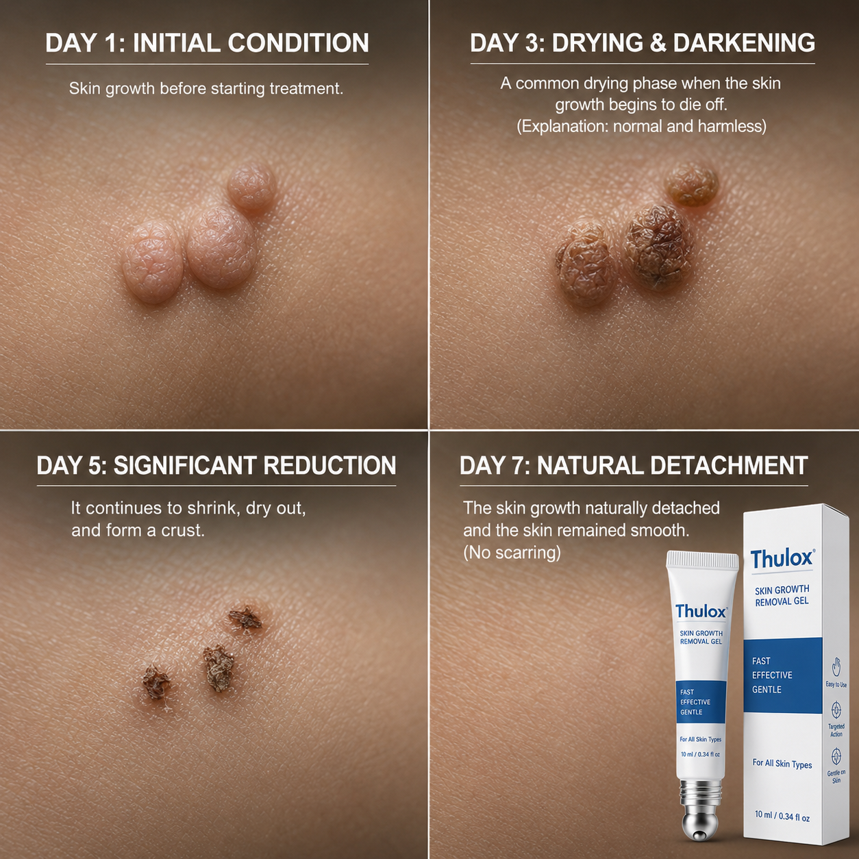 𝐎𝐟𝐟𝐢𝐜𝐢𝐚𝐥 𝐒𝐭𝐨𝐫𝐞 𝐁𝐫𝐚𝐧𝐝 | Tlulox®  👩‍⚕️ 𝐓𝐥𝐮𝐥𝐨𝐱® 7-Day Skin Tag & Dark Spot Remover (Pain-free roll-on applicator · No scars · Gentle skin care solution) 🌱
