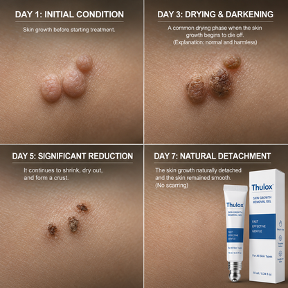 𝐎𝐟𝐟𝐢𝐜𝐢𝐚𝐥 𝐒𝐭𝐨𝐫𝐞 𝐁𝐫𝐚𝐧𝐝 | Tlulox®  👩‍⚕️ 𝐓𝐥𝐮𝐥𝐨𝐱® 7-Day Skin Tag & Dark Spot Remover (Pain-free roll-on applicator · No scars · Gentle skin care solution) 🌱