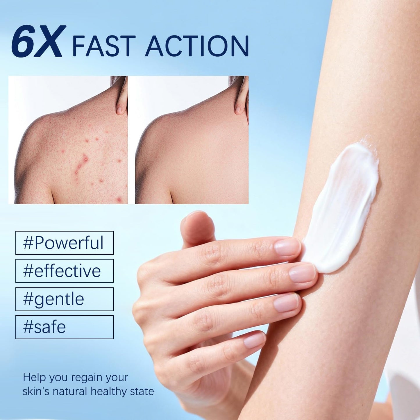 TrueRelief Folliculitis Cream