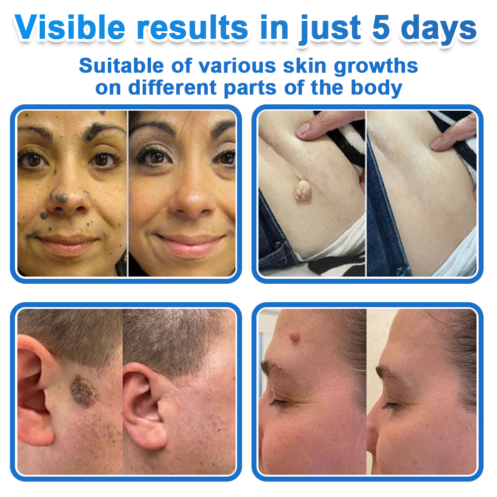 🔥 natravor® 2-in-1 Microneedle & Hydrocolloid Patch | Raised Moles,Acne,  Flat Warts & Skin Tags Remover | Improves Wrinkles, Scars & Blemishes | Invisible Pimple Patches for Face & Body