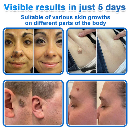 🔥 natravor® 2-in-1 Microneedle & Hydrocolloid Patch | Raised Moles,Acne,  Flat Warts & Skin Tags Remover | Improves Wrinkles, Scars & Blemishes | Invisible Pimple Patches for Face & Body