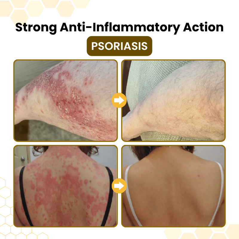Timilk® PsoriaSoothe Bee Venom Skin-Restoration Cream ✨