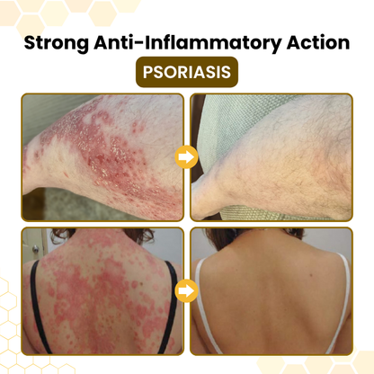 Timilk® PsoriaSoothe Bee Venom Skin-Restoration Cream ✨