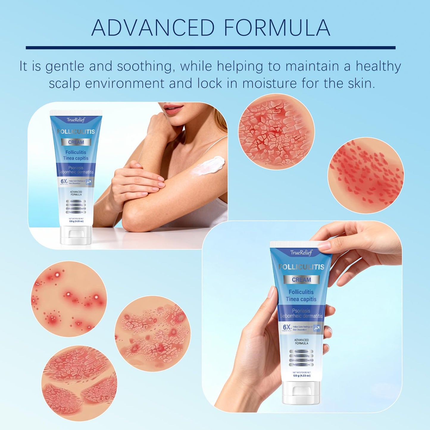 TrueRelief Folliculitis Cream