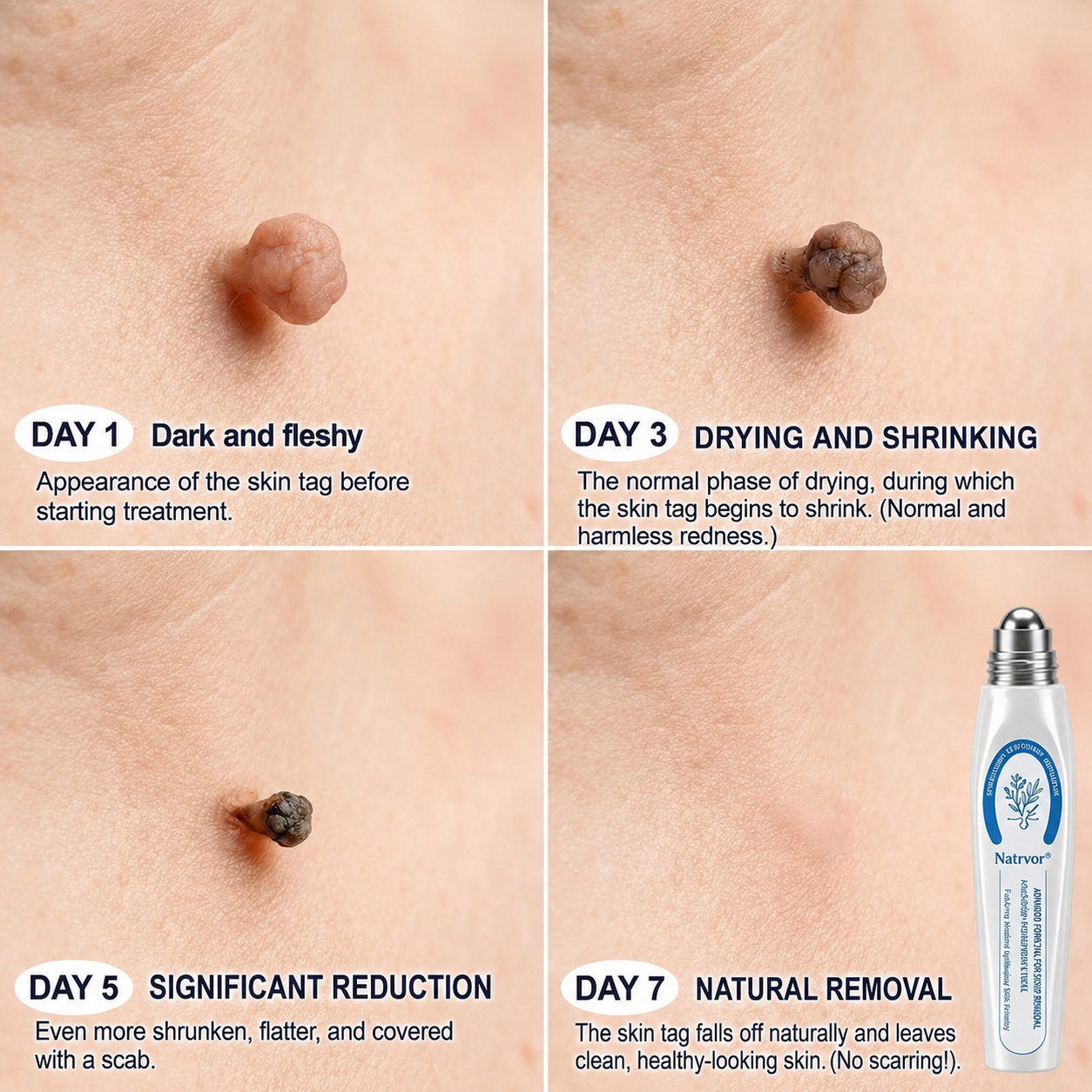 🔥 Natrvor® 7-Day Skin Tag & Dark Spot Care Roller Pain-Free • No Scar Marks • Precision Rollerball Applicator 🌈