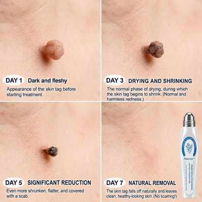 🔥 Natrvor® 7-Day Skin Tag & Dark Spot Care Roller Pain-Free • No Scar Marks • Precision Rollerball Applicator 🌈