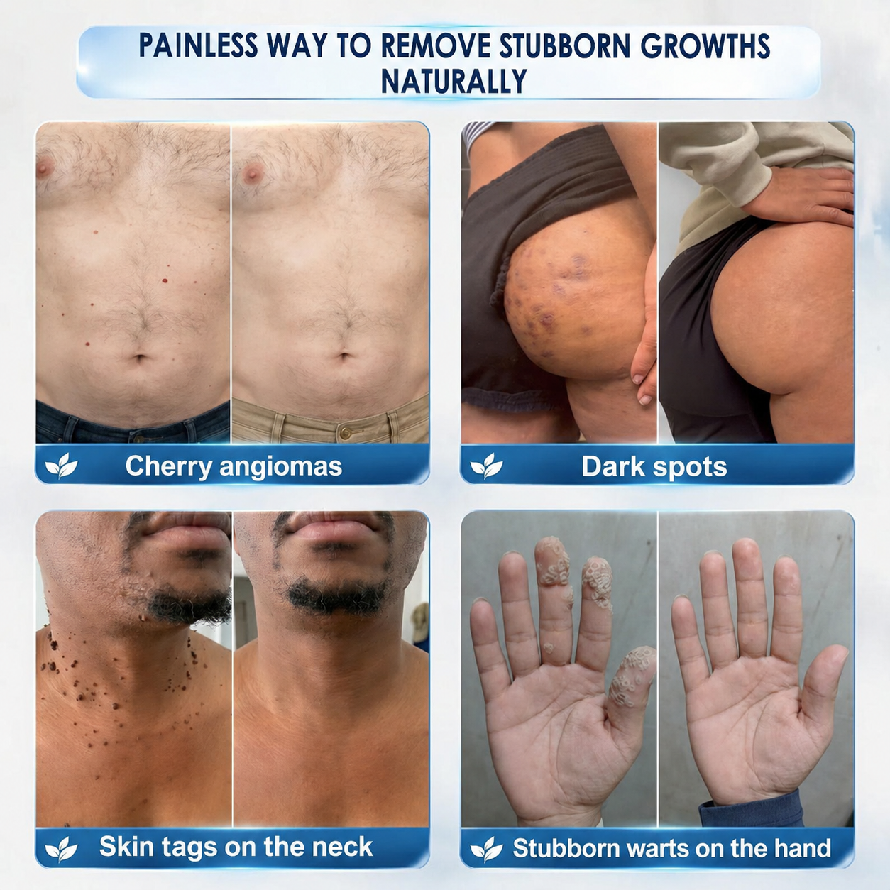 🔥 Natrvor® 7-Day Skin Tag & Dark Spot Care Roller Pain-Free • No Scar Marks • Precision Rollerball Applicator 🌈