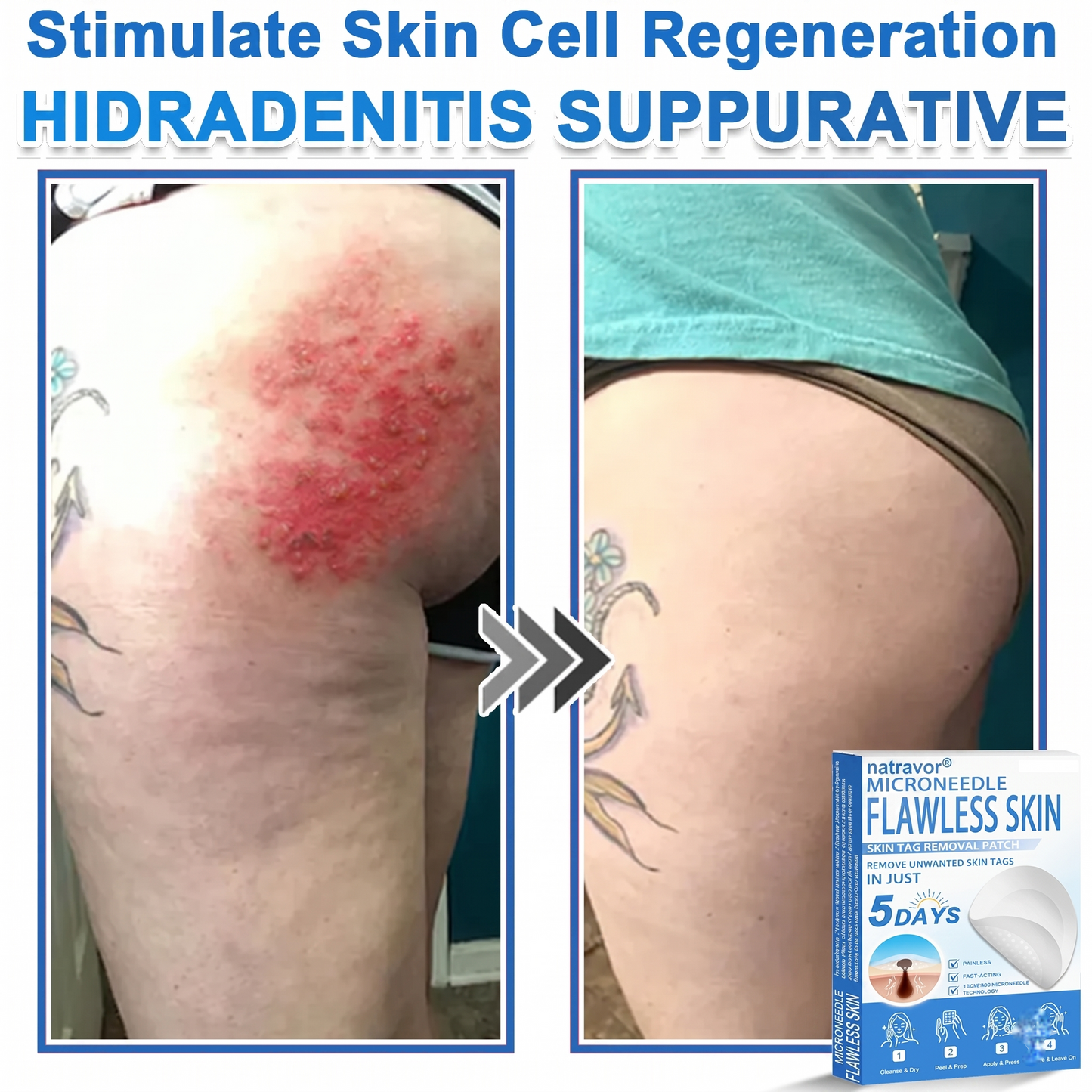 🔥 natravor® 2-in-1 Microneedle & Hydrocolloid Patch | Raised Moles,Acne,  Flat Warts & Skin Tags Remover | Improves Wrinkles, Scars & Blemishes | Invisible Pimple Patches for Face & Body