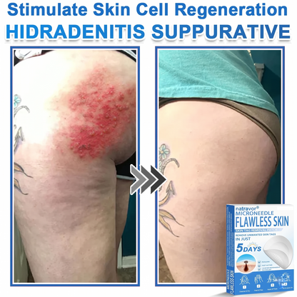 🔥 natravor® 2-in-1 Microneedle & Hydrocolloid Patch | Raised Moles,Acne,  Flat Warts & Skin Tags Remover | Improves Wrinkles, Scars & Blemishes | Invisible Pimple Patches for Face & Body