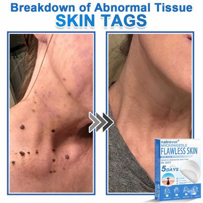 🔥 natravor® 2-in-1 Microneedle & Hydrocolloid Patch | Raised Moles,Acne,  Flat Warts & Skin Tags Remover | Improves Wrinkles, Scars & Blemishes | Invisible Pimple Patches for Face & Body